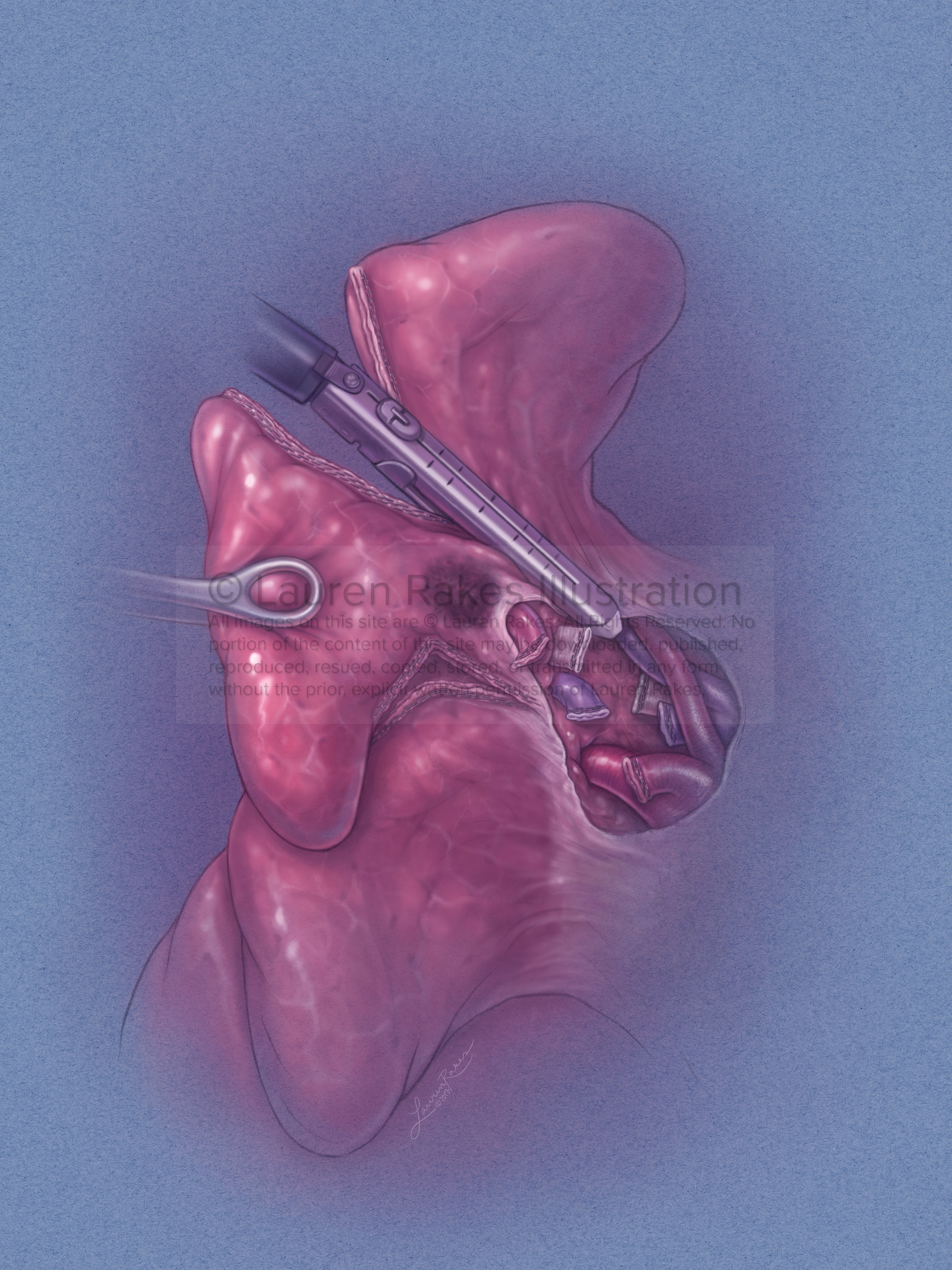 Lung Segmentectomy